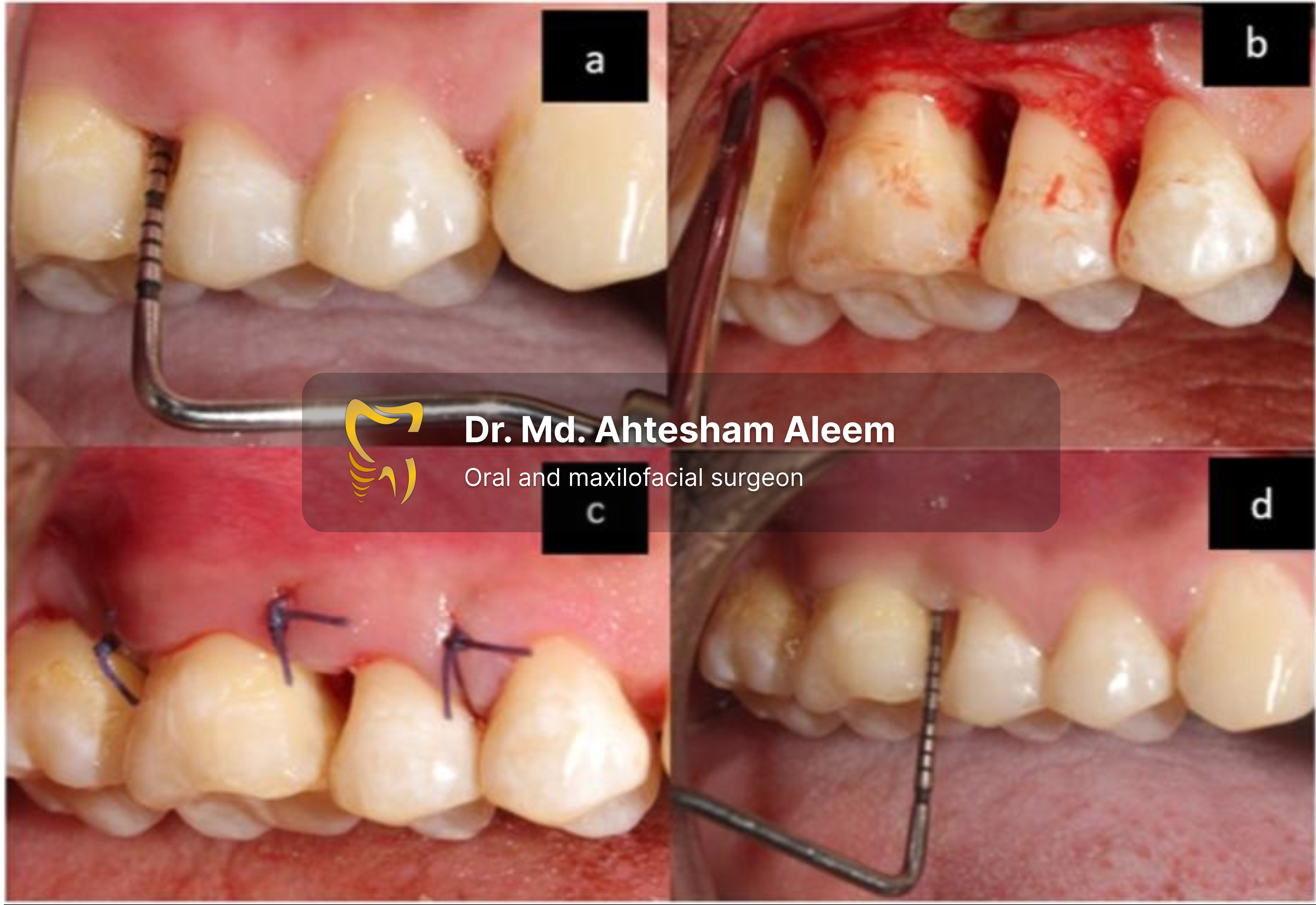 Gum Flap Surgery Gallery 1